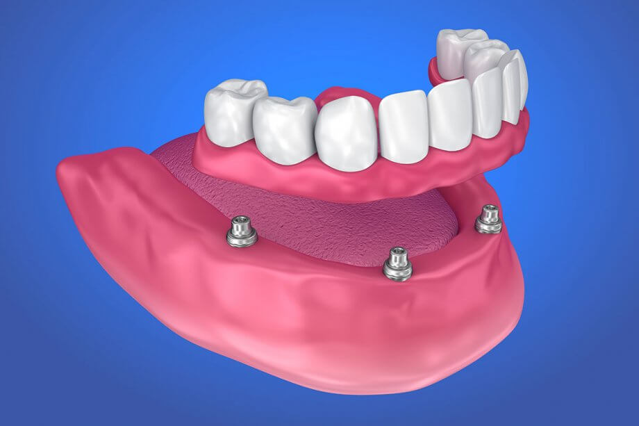 The Benefits of Dental Implant Supported Dentures