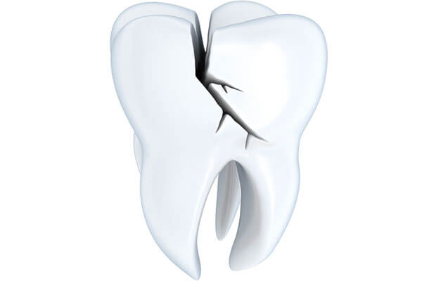 Cracked Teeth Dental Care in RI