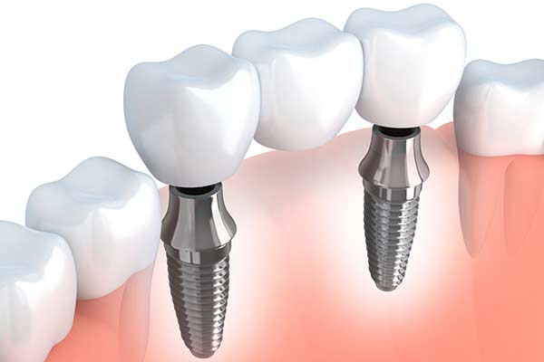 Dental Implant Supported Bridges in RI