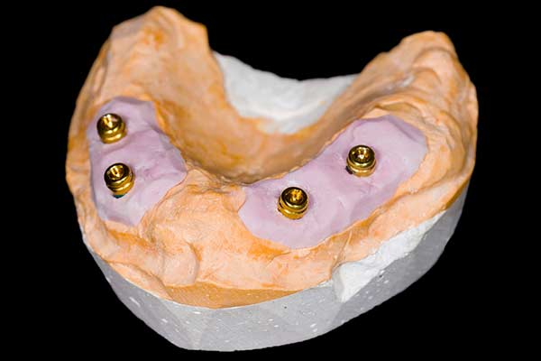 All-on-4 Restorations in South County, RI
