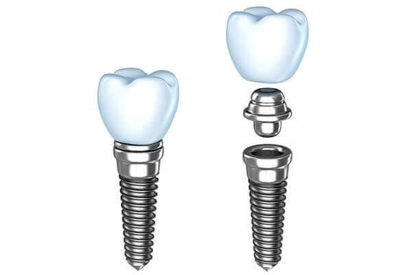 Single Dental Implants in South County