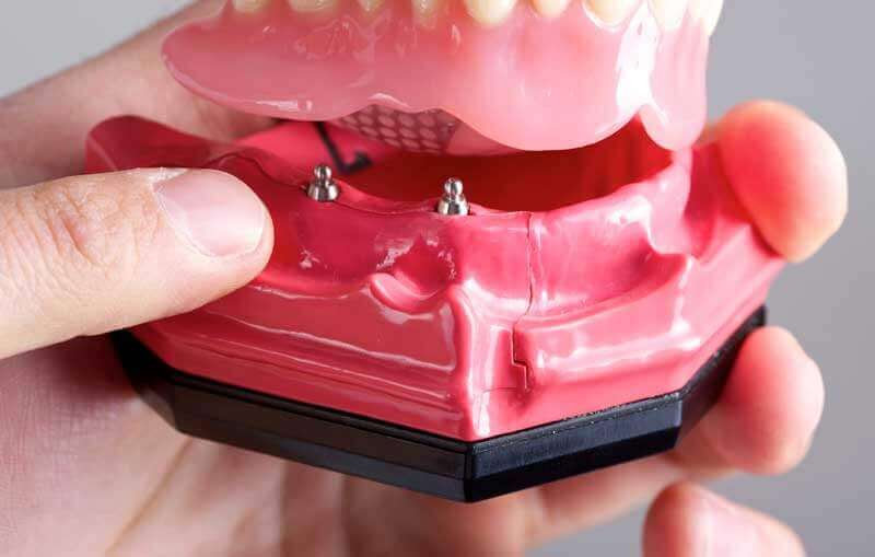 Mini Dental Implants in South County, RI