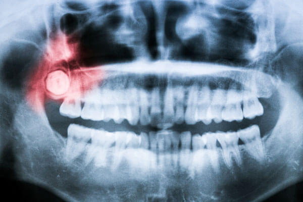 Impacted Tooth & Tooth Exposure