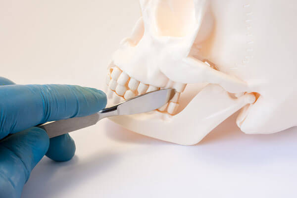 Sinus Lift