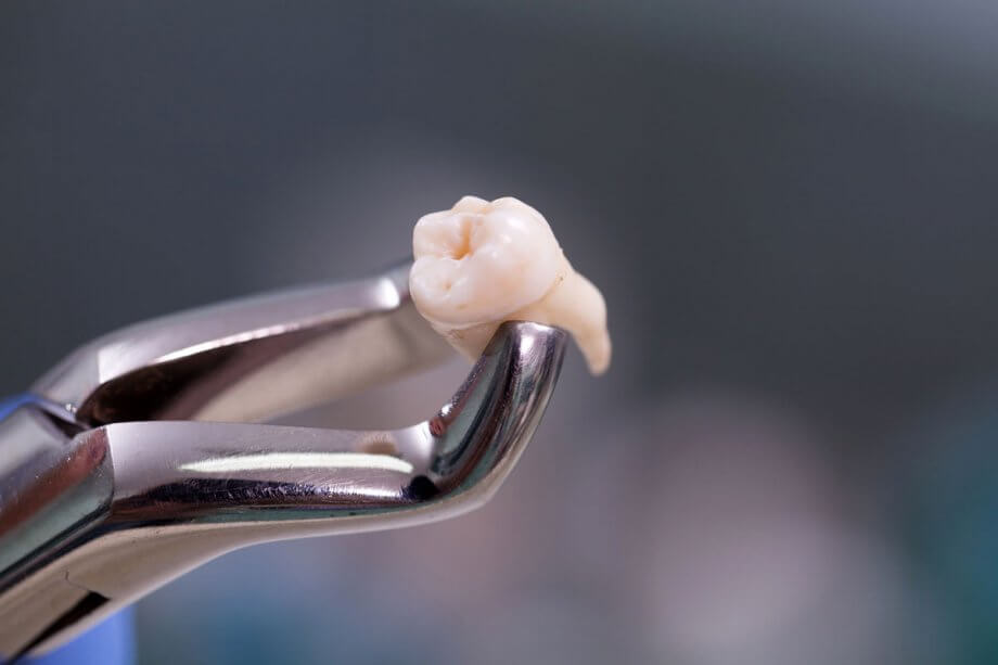 What to Expect After Wisdom Tooth Extraction