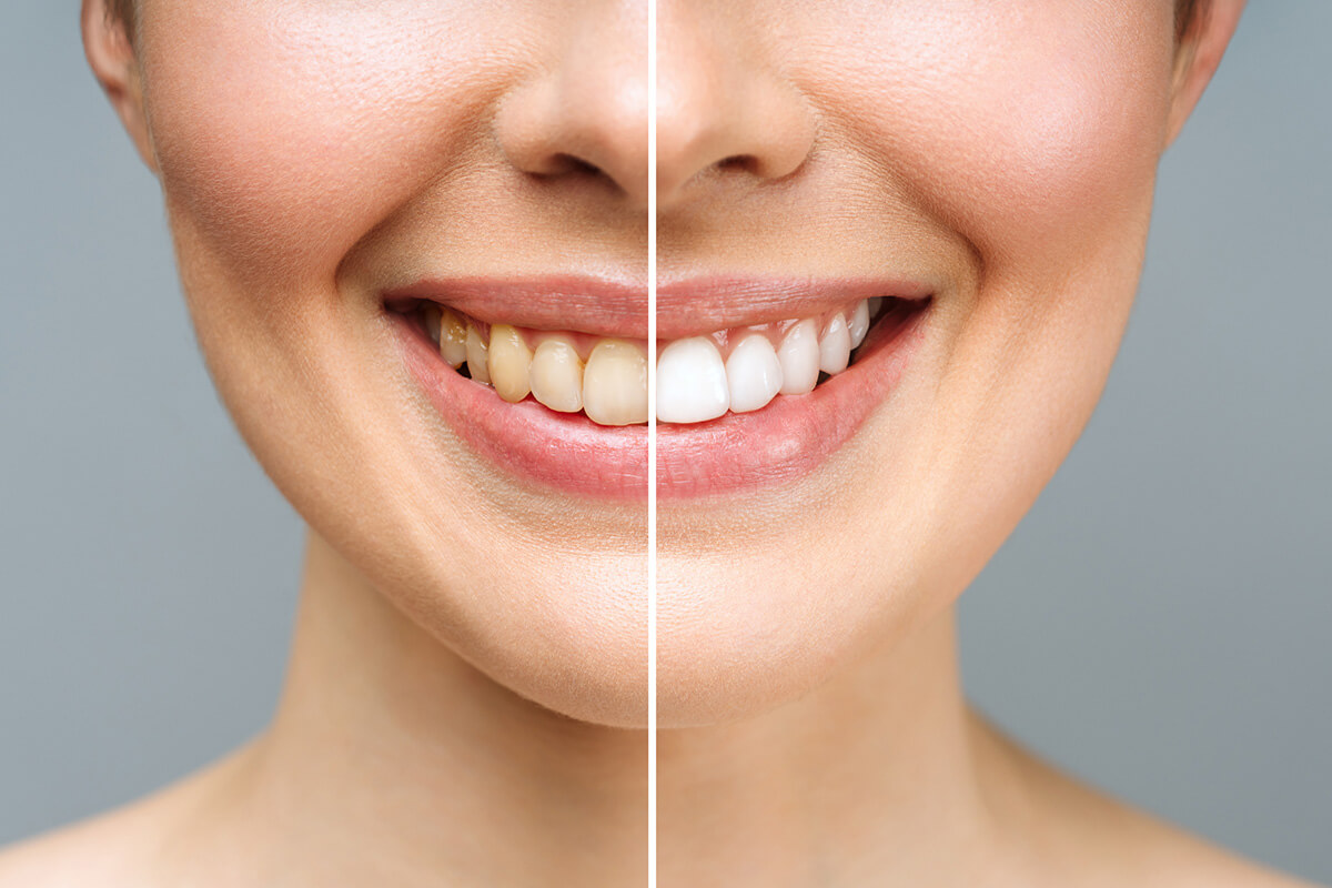 Before & After Teeth Whitening in Charlestown