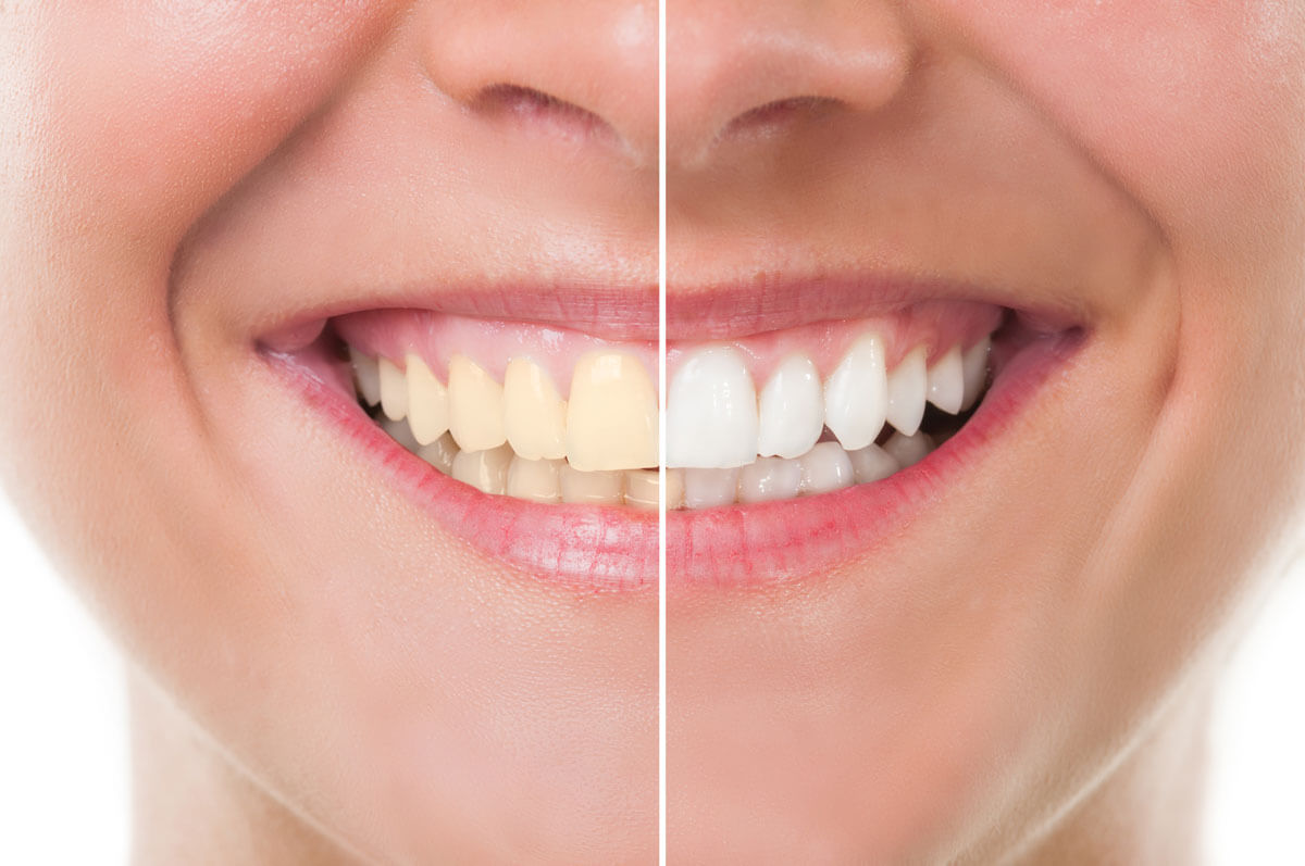 Before & After Teeth Whitening in Charlestown